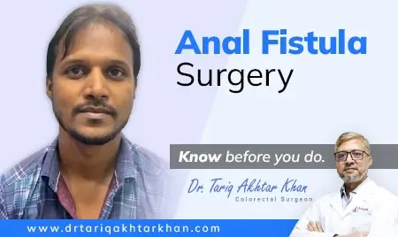 Anal Fistula Surgery Feedback