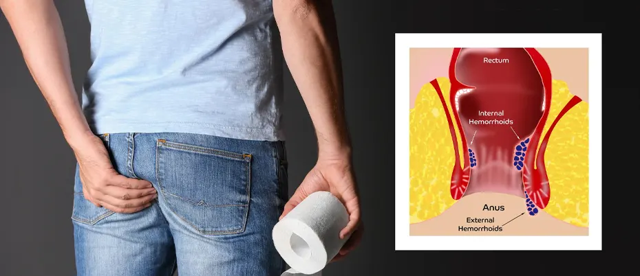 Person with anal discomfort and hemorrhoids