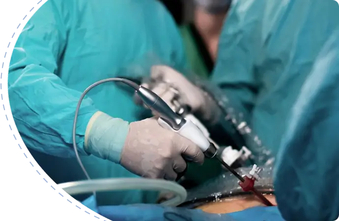 Pilonidal sinus surgery cost in Bangladesh