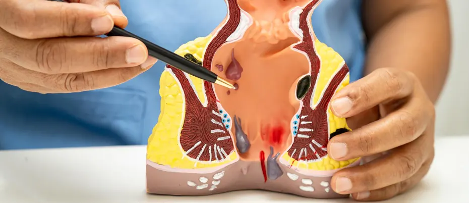 Proctitis and Rectal pain: Causes, treatment and surgery in Bangladesh